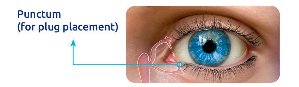 Diagram showing placement of punctal plug on the inside of the eye next to the bridge of the nose.